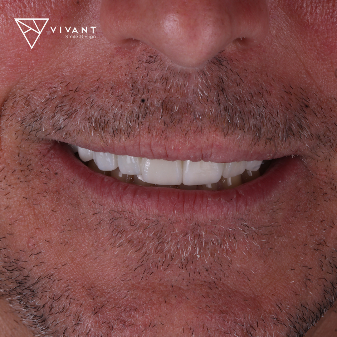 VIVANTSMILEDESINGBRIDGE-OVER-IMPLANT2