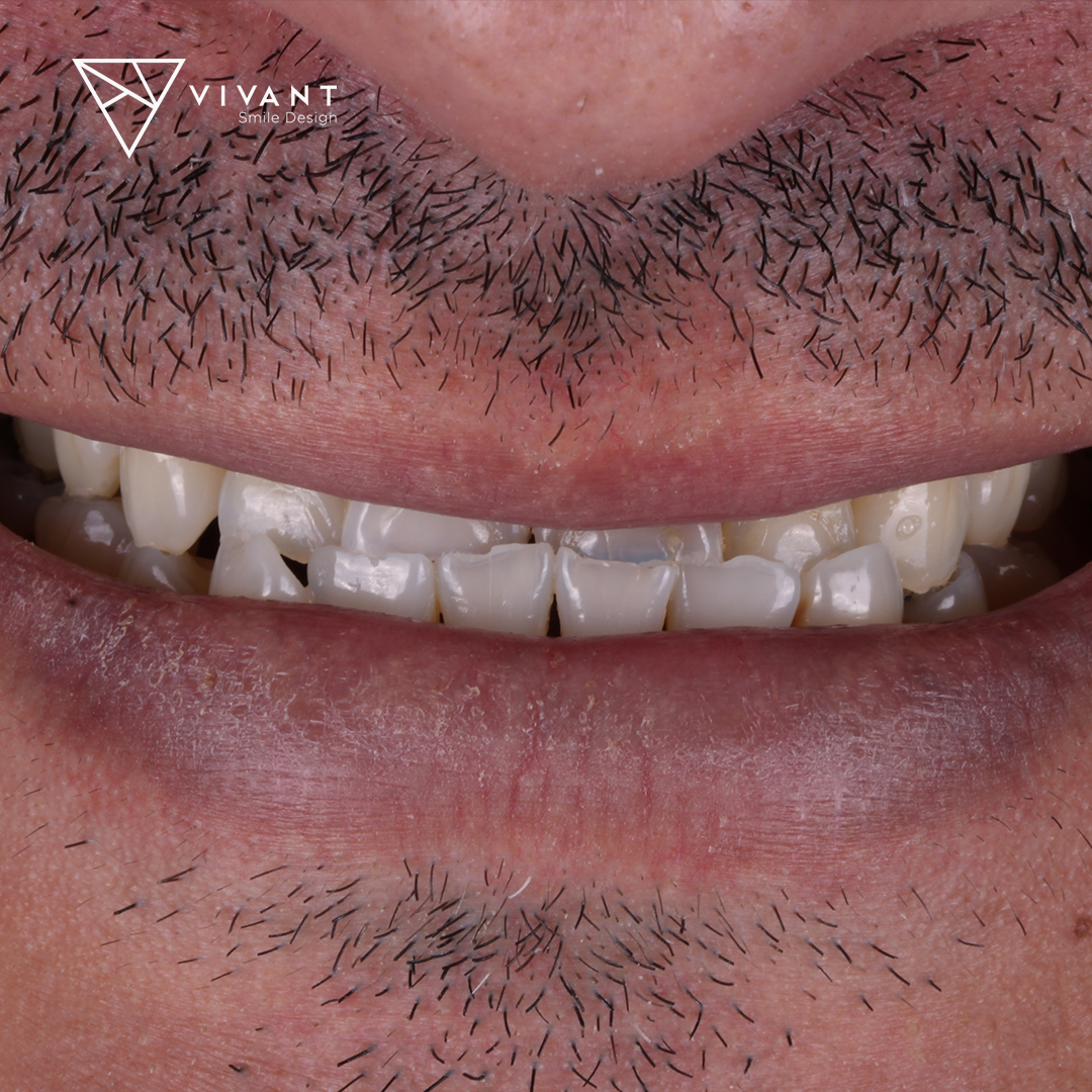 Vivantsmiledesingcasosmile10