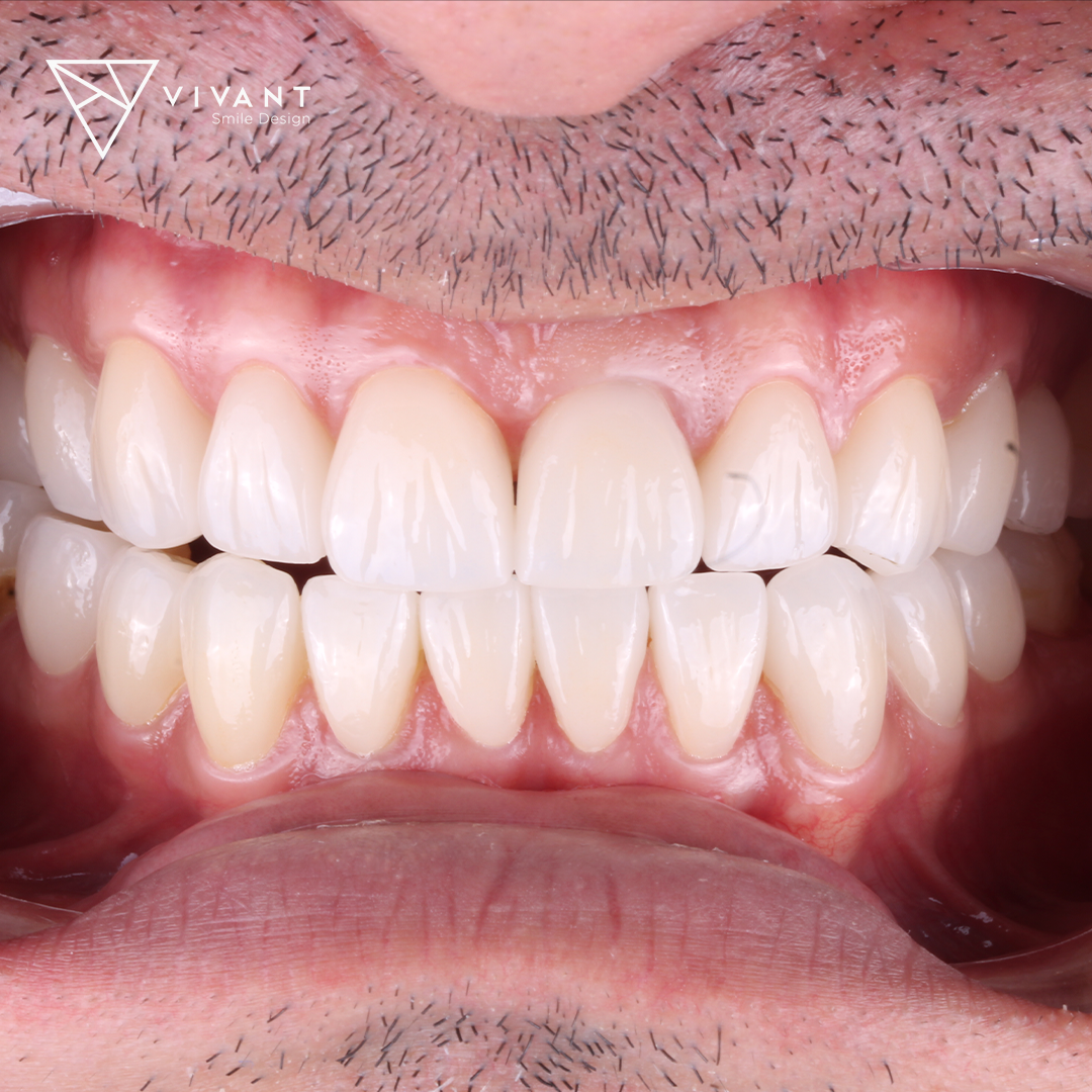 Vivantsmiledesingcasosmile4-1