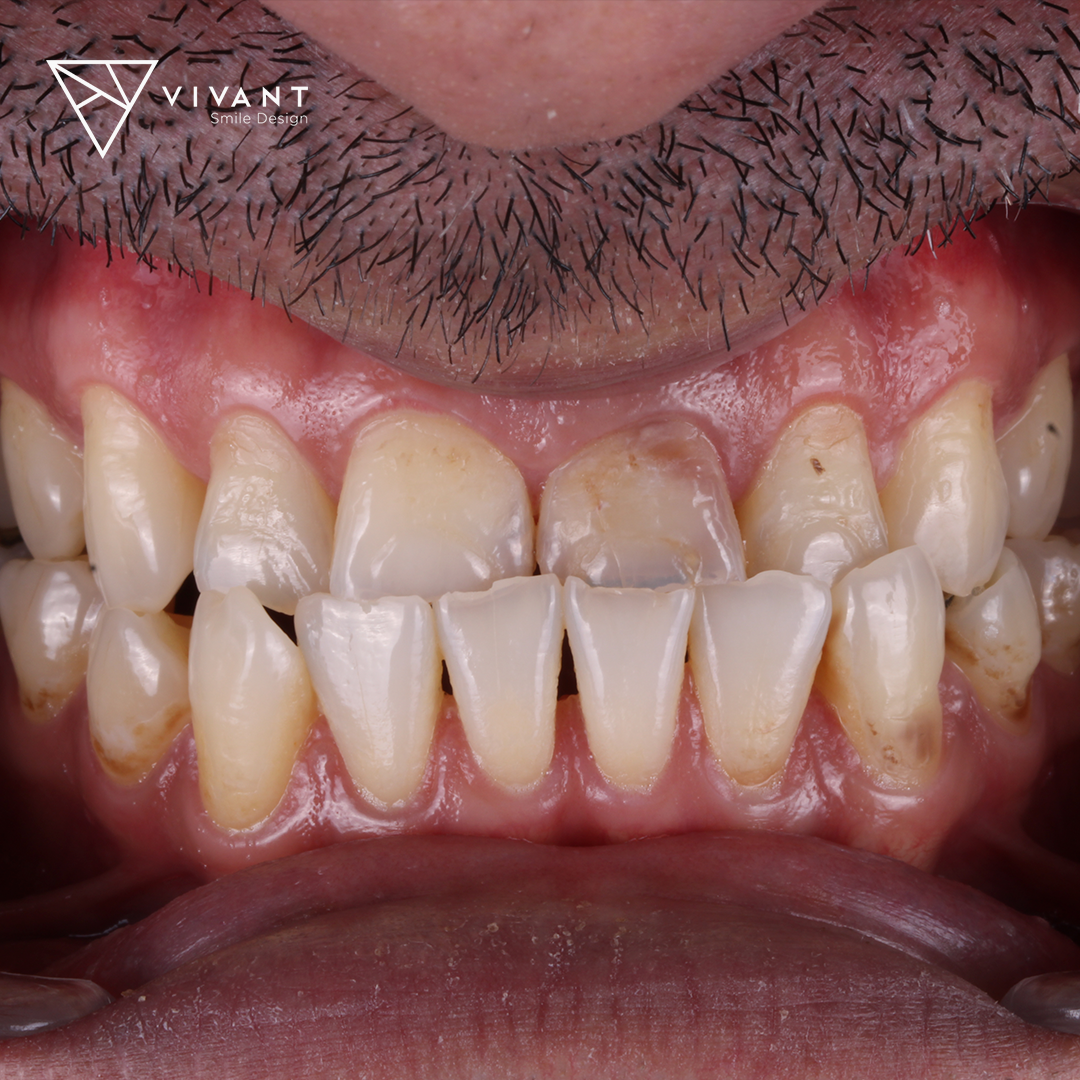 Vivantsmiledesingcasosmile6
