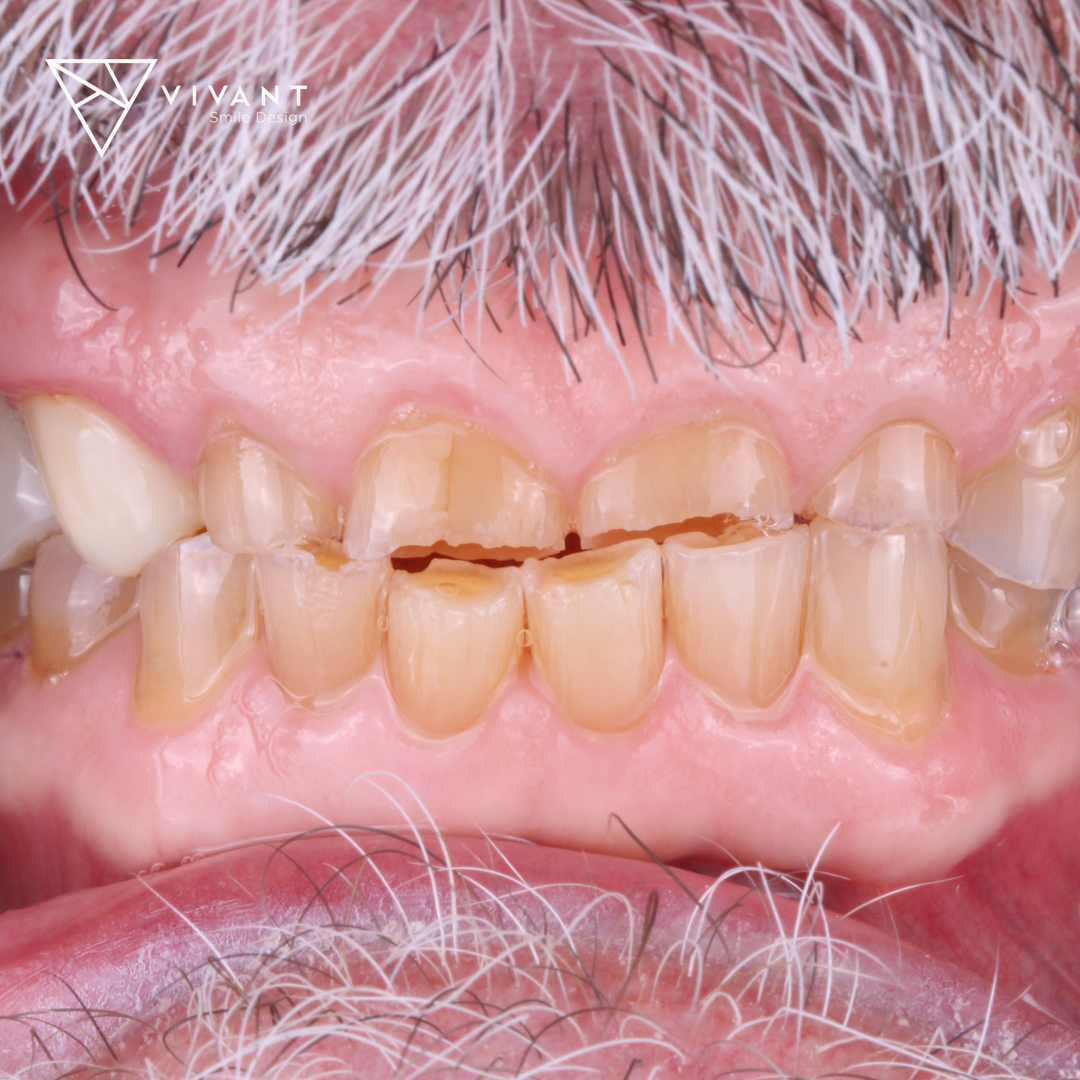 Vivantsmiledesinglosalgodonescrowns2-1