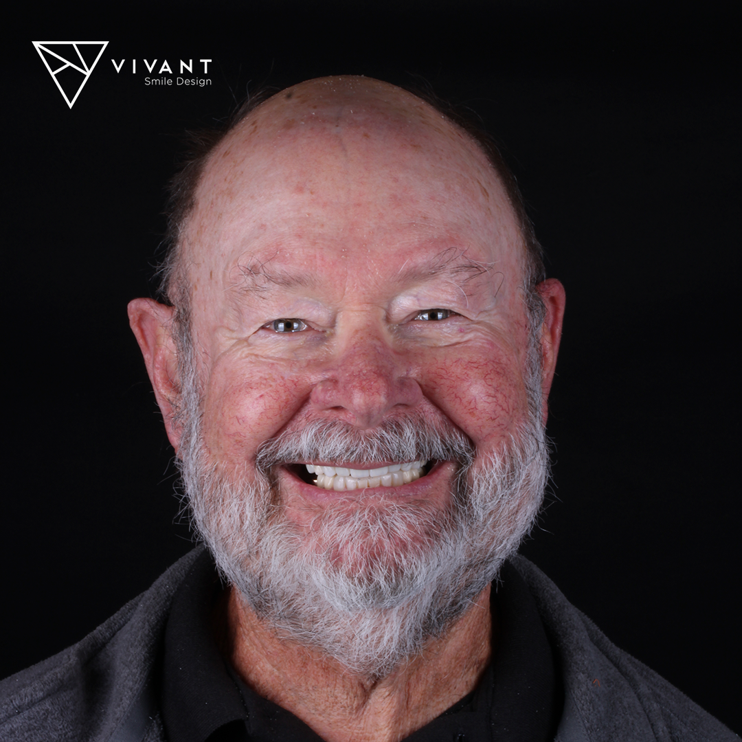 Vivantsmiledesinglosalgodonescrowns3-1