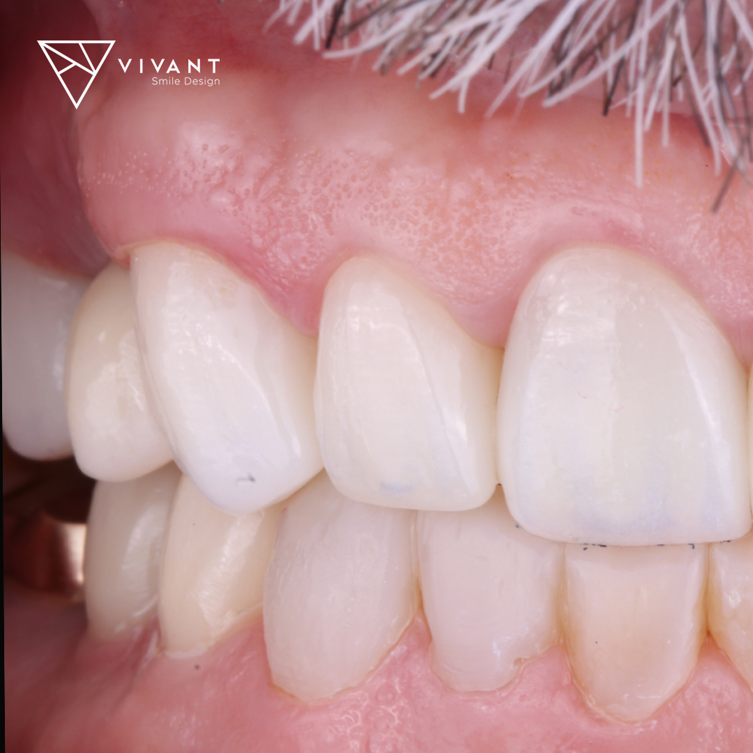 Vivantsmiledesinglosalgodonescrowns5