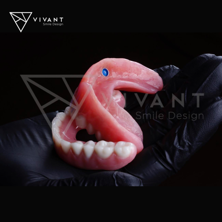 vivantsmiledesingIMPLANTES-SNAP-ON2-768x768