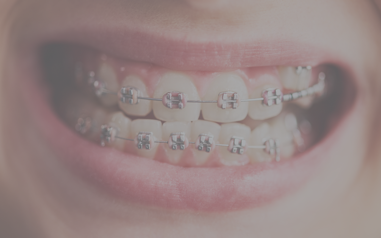 Consequences of Poor Oral Hygiene During Orthodontic Treatment – Vivant Smile Design.