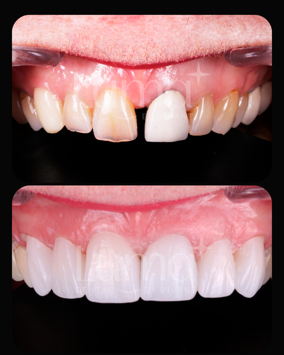 Dental Crown en los alkgodones