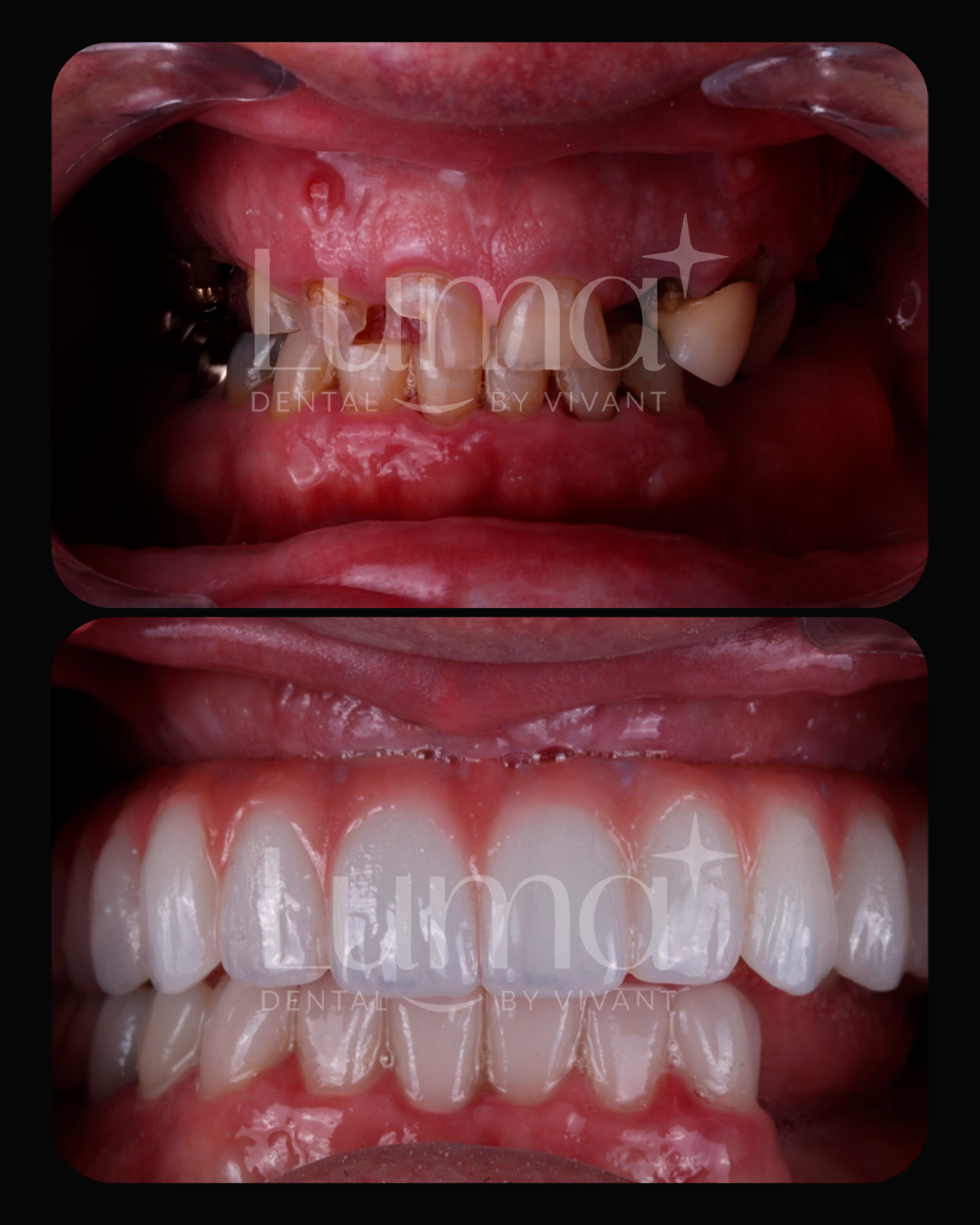 Dental Implants at LUMA