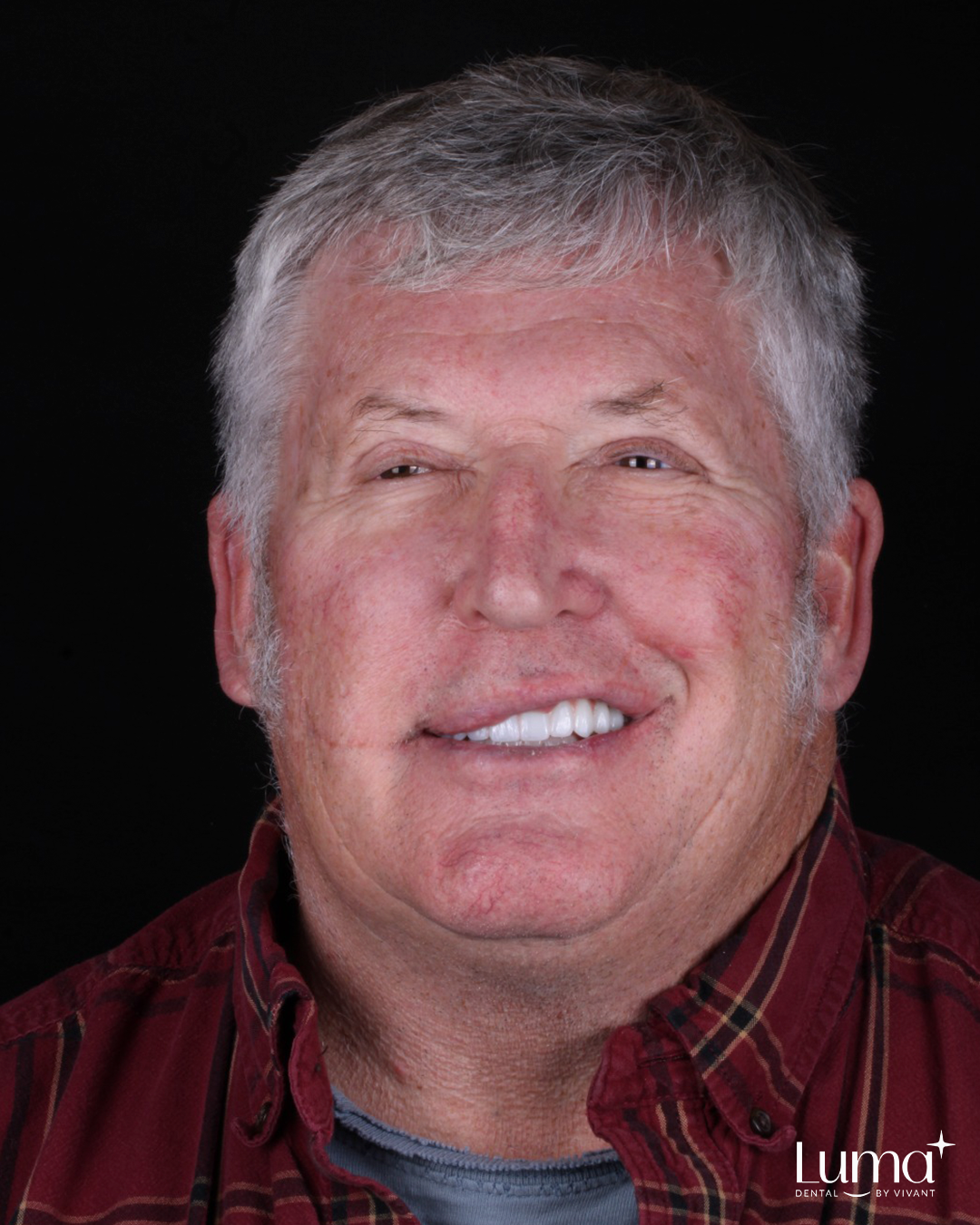 Dental Implants at LUMA Dental in los algodones