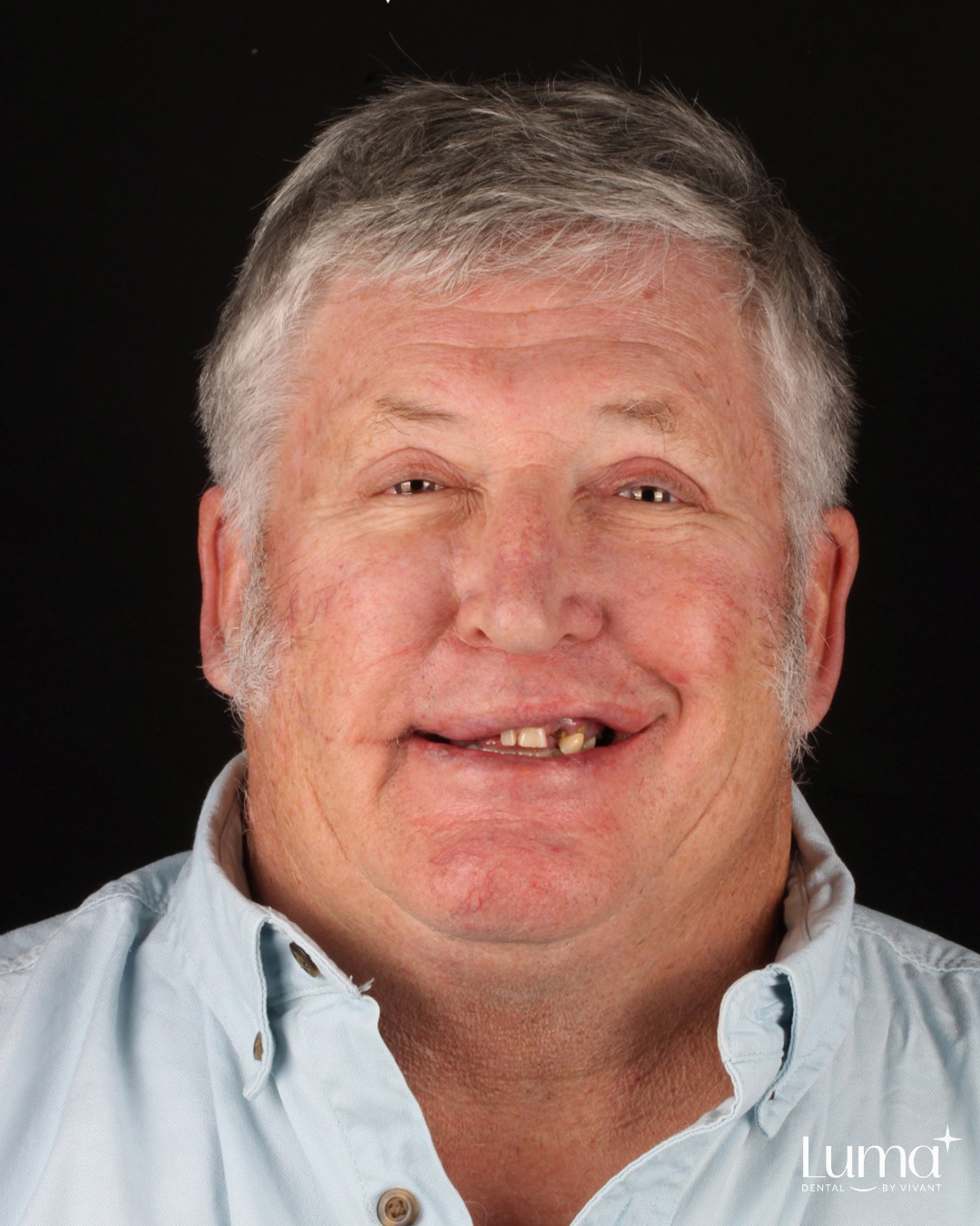 Dental Implants at LUMA Dental