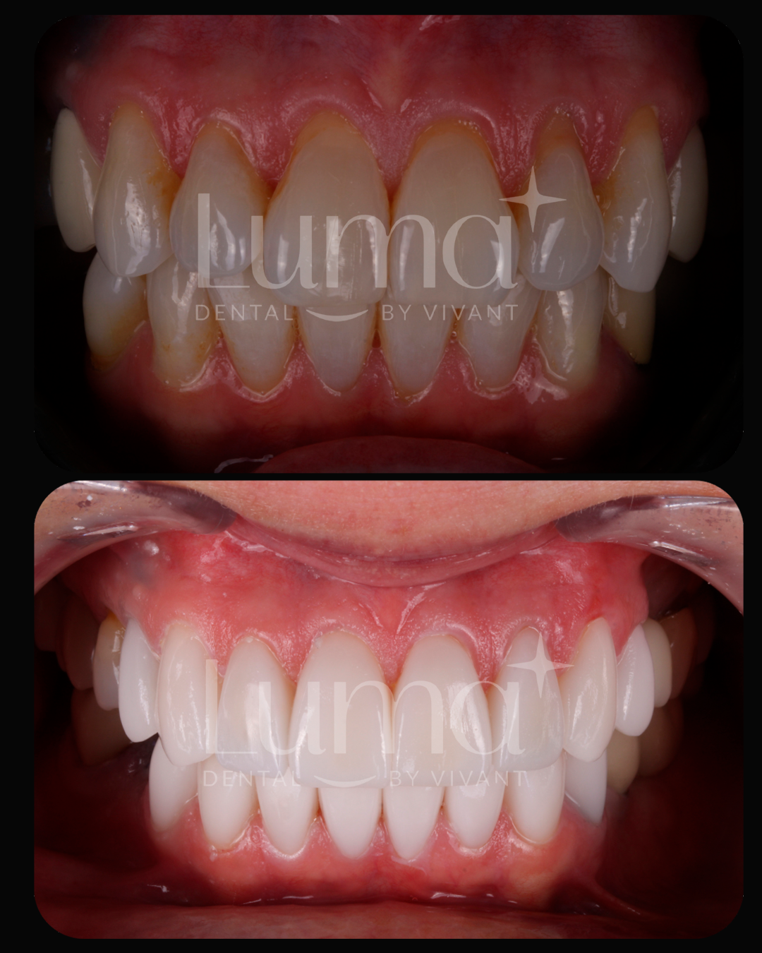 Dental Veneers in lumma