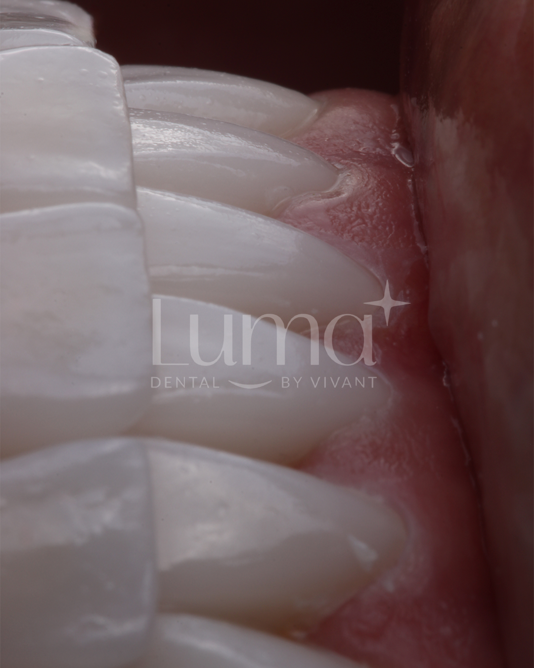 LUMA