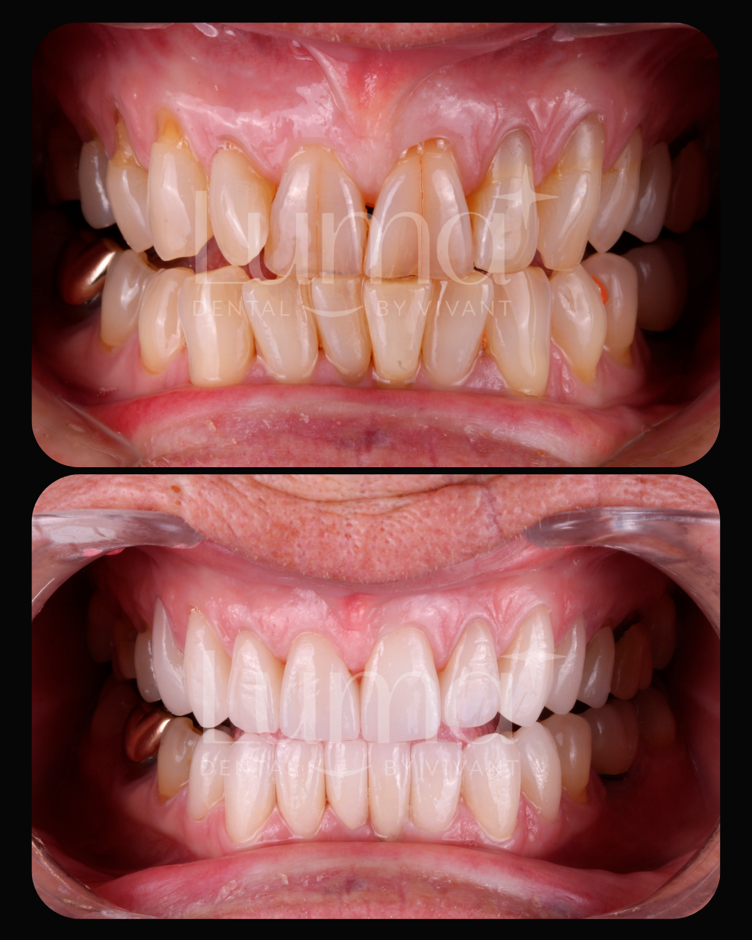Oral Rehabilitation at LUMA Dental 2